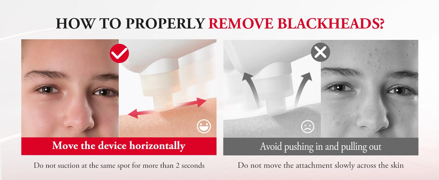 ANLAN Electric Water Vacuum Blackhead Remover Pore Cleaner Facial Hydro Cleanse Skincare Device for Whitehead And Acne Suction