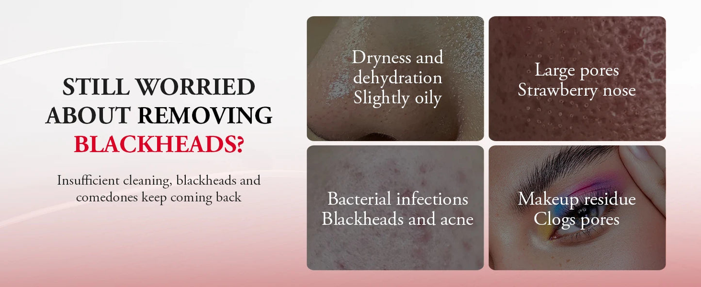 ANLAN Electric Water Vacuum Blackhead Remover Pore Cleaner Facial Hydro Cleanse Skincare Device for Whitehead And Acne Suction