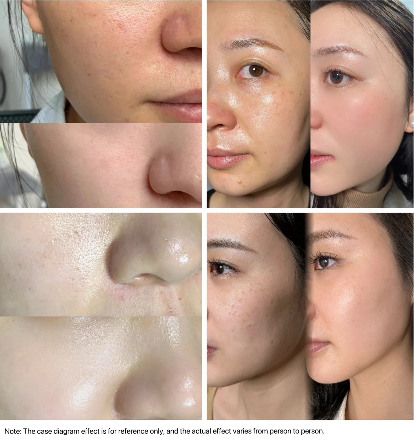 DPL skin rejuvenation photorejuvenation skincare device IPL Anti-Aging Device for Face Wrinkle Removal Pigment Removal Home Use